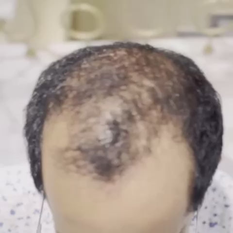 Men Patches | 100% Human Hair | Natural and Seamless Hair Extensions HairOriginals